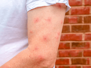 39 hervorragende Hausmittel, um Mückenstiche loszuwerden