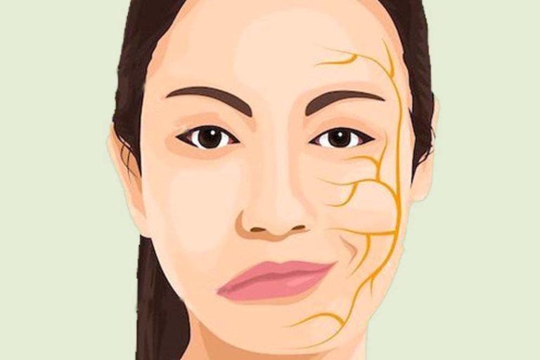 Beeinträchtigt die Fazialisparese das Sehvermögen die Sprache und wie viel B12 sollte ich dagegen einnehmen